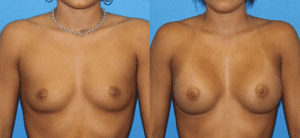 Is Breast Augmentation Good for You?