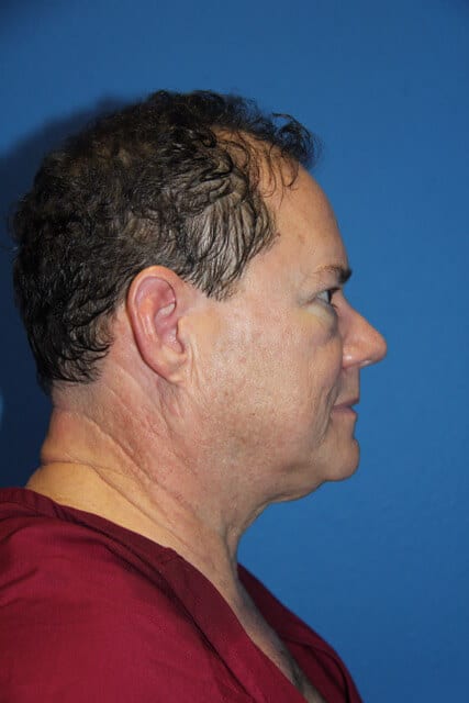 Male Facelift Patient 01 View 3 - Before Thumbnail