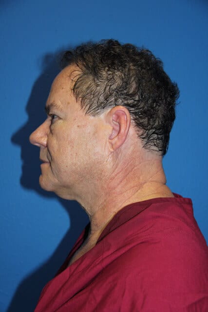 Male Facelift Patient 01 View 5 - Before Thumbnail