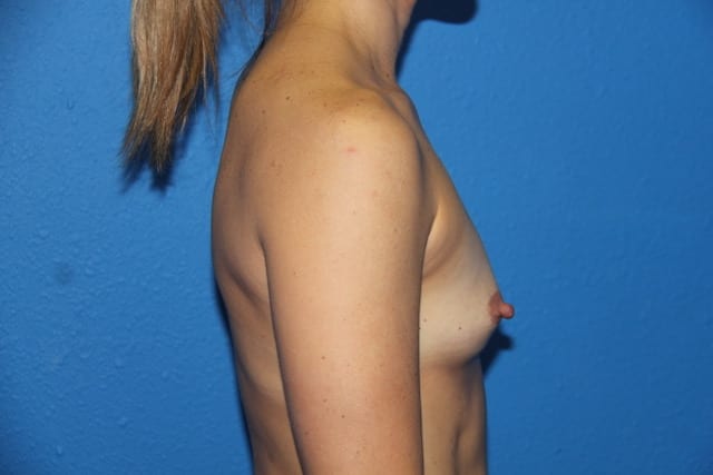 Breast Augmentation Patient 02 View 4 - Before Thumbnail