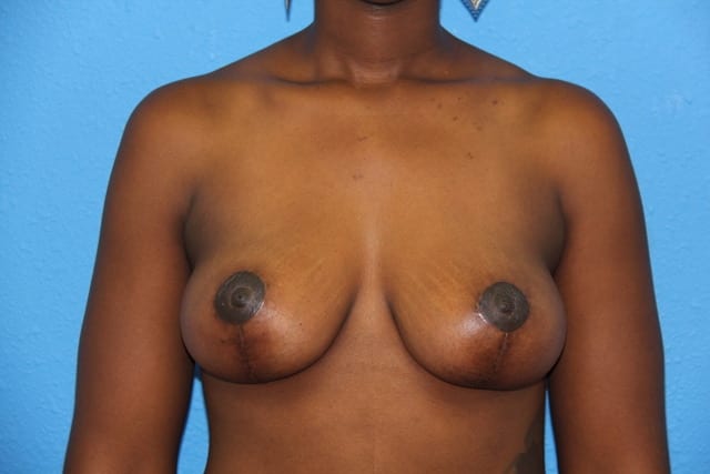Breast Reduction Patient 01 View 1 - After Thumbnail