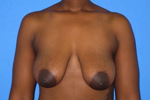 Breast Reduction Patient 01 View 1 - Before Thumbnail