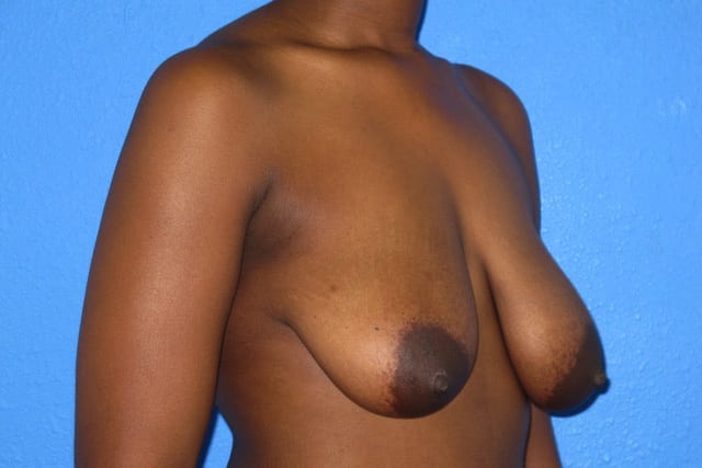 Breast Reduction Patient 01 View 2 - Before Thumbnail