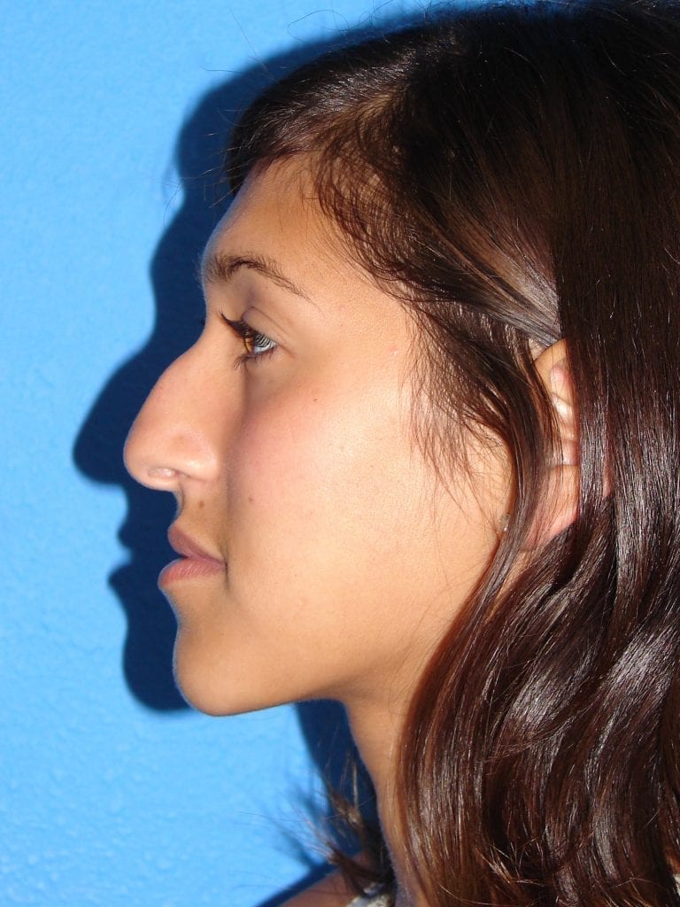Rhinoplasty Patient 02 View 1 - Before Thumbnail