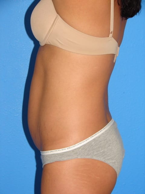 Mommy Makeover Patient 01 (Breast Augmentation and Tummy Tuck) View 3 - Before Thumbnail