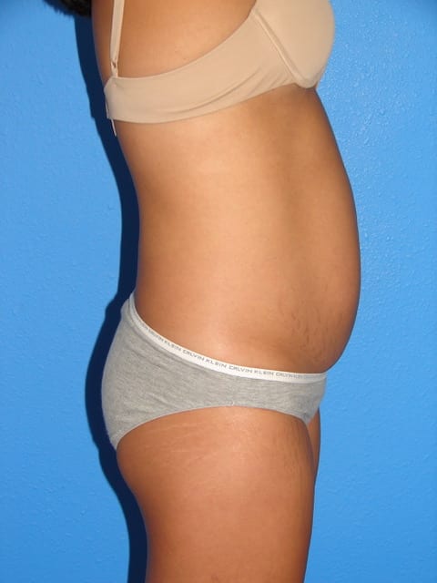 Mommy Makeover Patient 01 (Breast Augmentation and Tummy Tuck) View 2 - Before Thumbnail