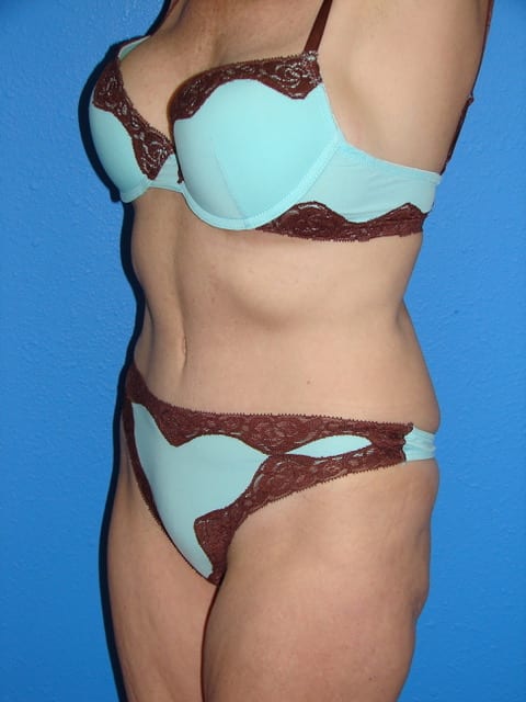 Mommy Makeover Patient 02 (Breast Augmentation and Tummy Tuck) View 3 - After Thumbnail