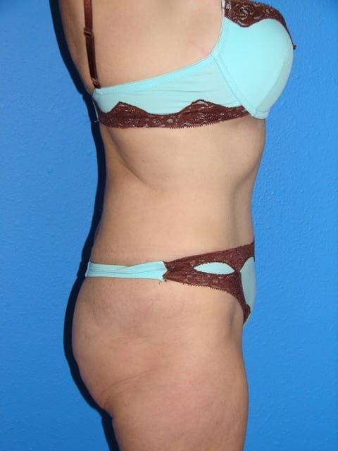 Mommy Makeover Patient 02 (Breast Augmentation and Tummy Tuck) View 4 - After Thumbnail