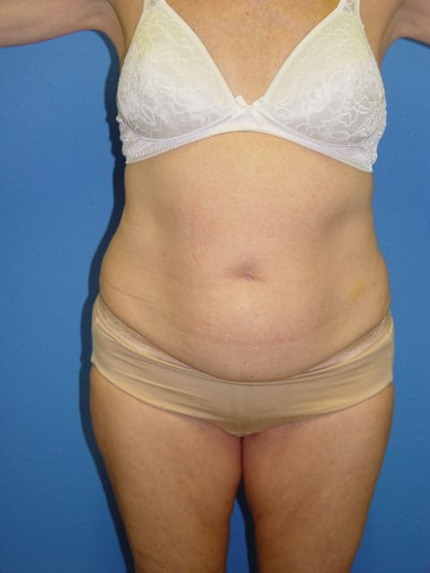 Mommy Makeover Patient 02 (Breast Augmentation and Tummy Tuck) View 1 - Before Thumbnail