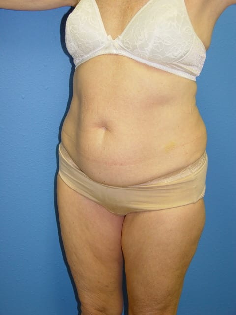 Tummy Tuck Patient 04 View 4 - Before Thumbnail