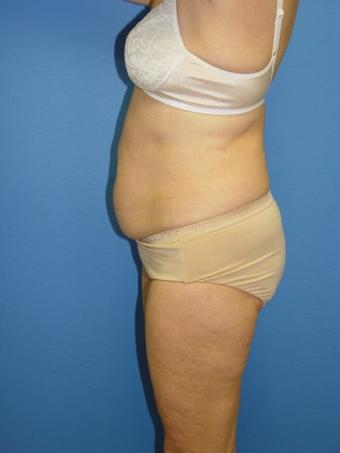 Tummy Tuck Patient 04 View 3 - Before Thumbnail