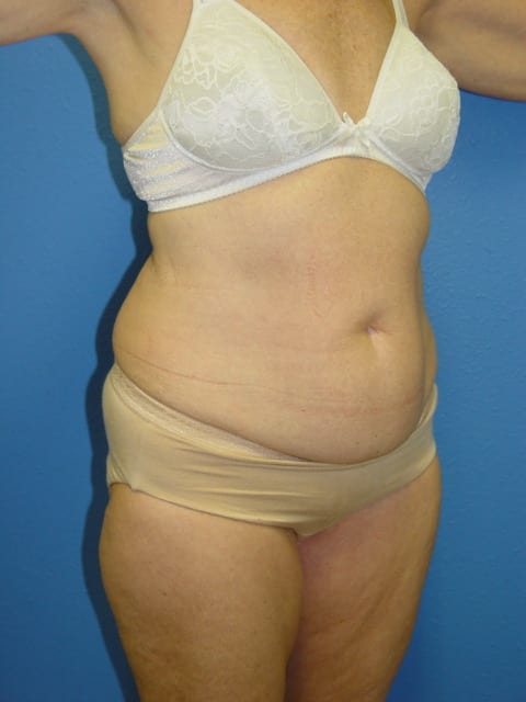 Mommy Makeover Patient 02 (Breast Augmentation and Tummy Tuck) View 2 - Before Thumbnail