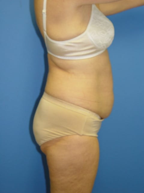 Mommy Makeover Patient 02 (Breast Augmentation and Tummy Tuck) View 4 - Before Thumbnail