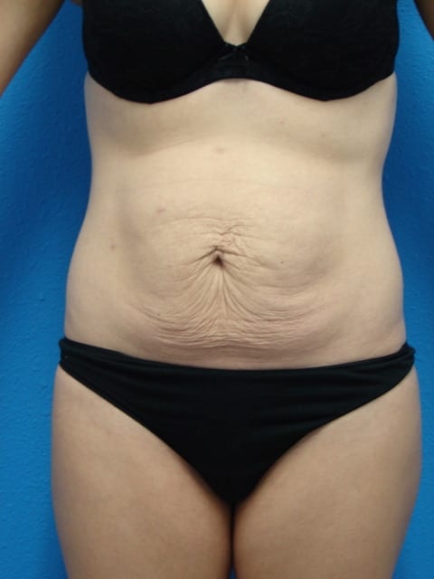 Tummy Tuck Patient 01 View 1 - Before Thumbnail