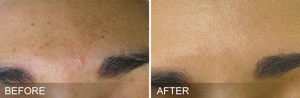 Hydrafacial actual patient results Brows