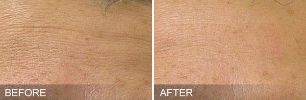 Hydrafacial actual patient results forehead