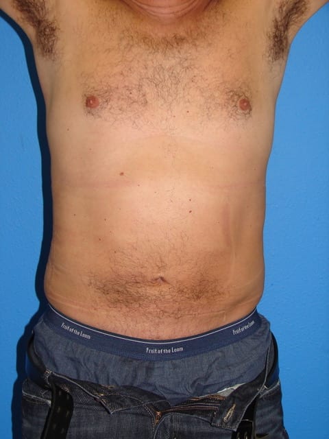 Male Liposuction Patient 02 View 1 - After Thumbnail