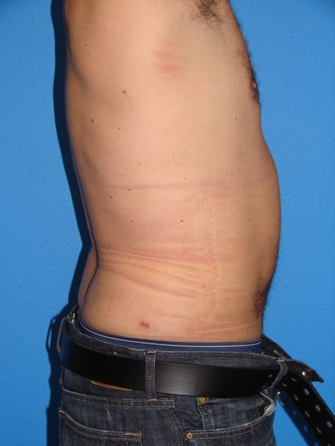 Male Liposuction Patient 02 View 2 - After Thumbnail