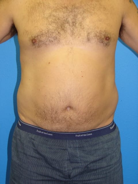 Male Liposuction Patient 02 View 1 - Before Thumbnail