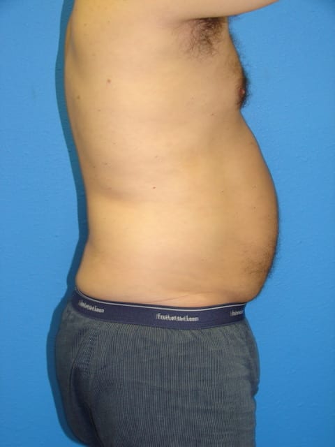 Male Liposuction Patient 02 View 2 - Before Thumbnail