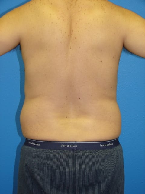 Male Liposuction Patient 02 View 3 - Before Thumbnail