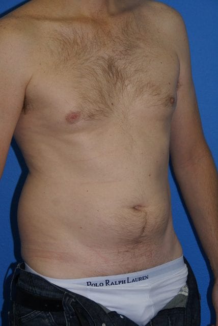 Male Liposuction Patient 01 View 3 - Before Thumbnail