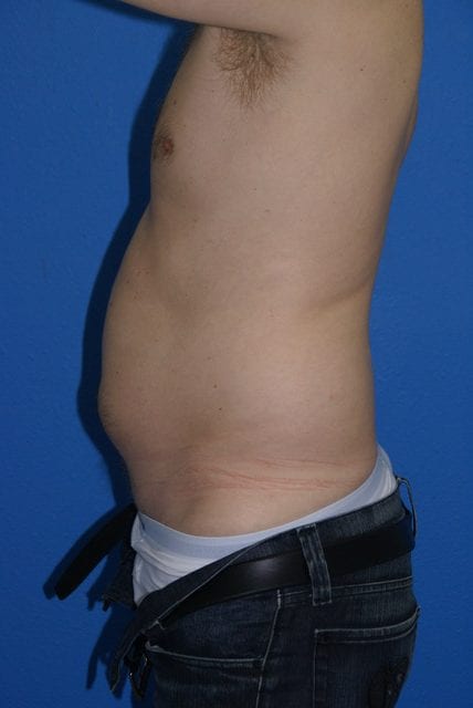 Male Liposuction Patient 01 View 5 - Before Thumbnail