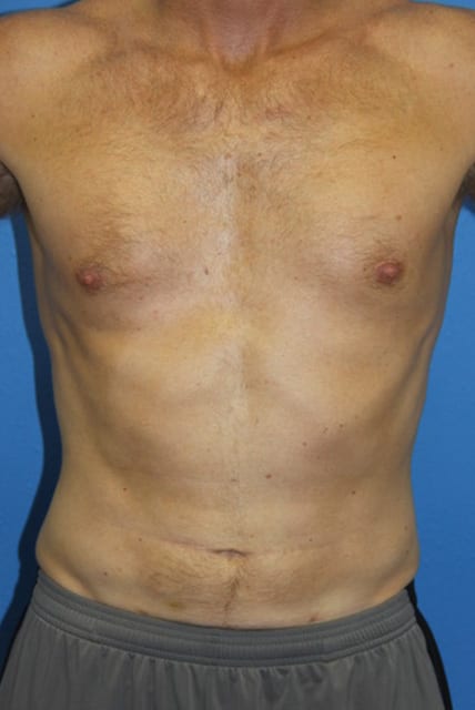 Male Liposuction Patient 01 View 1 - After Thumbnail