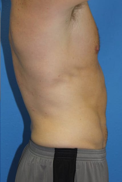 Male Liposuction Patient 01 View 4 - After Thumbnail