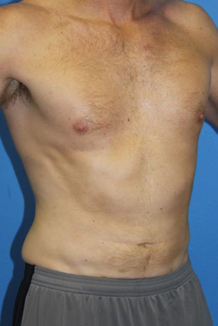 Male Liposuction Patient 01 View 3 - After Thumbnail