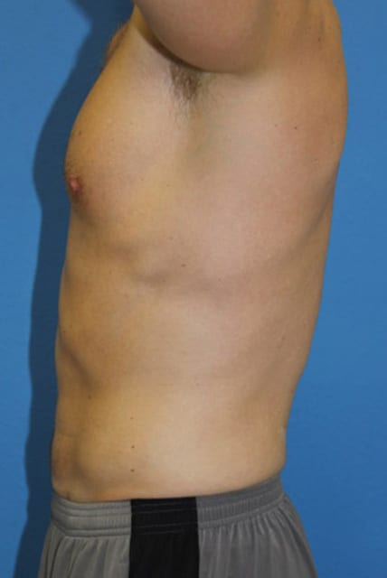 Male Liposuction Patient 01 View 5 - After Thumbnail