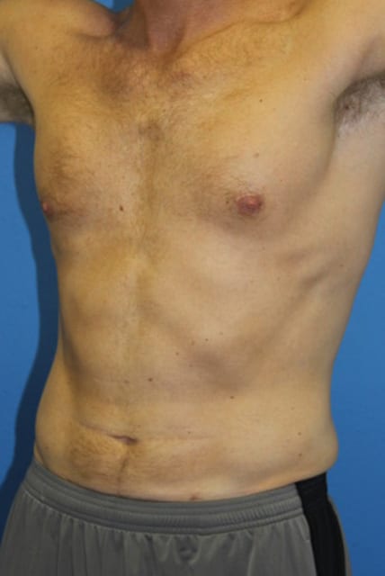 Male Liposuction Patient 01 View 2 - After Thumbnail