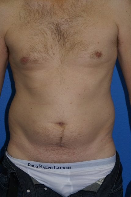 Male Liposuction Patient 01 View 1 - Before Thumbnail