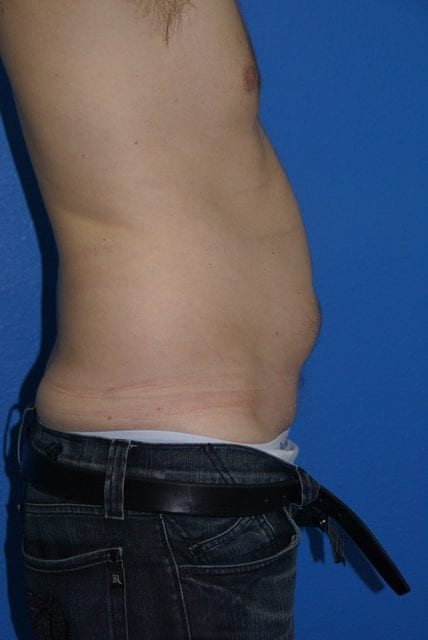 Male Liposuction Patient 01 View 4 - Before Thumbnail
