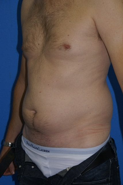 Male Liposuction Patient 01 View 2 - Before Thumbnail