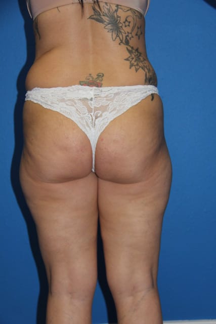 Liposuction Patient 01 View 7 - Before Thumbnail