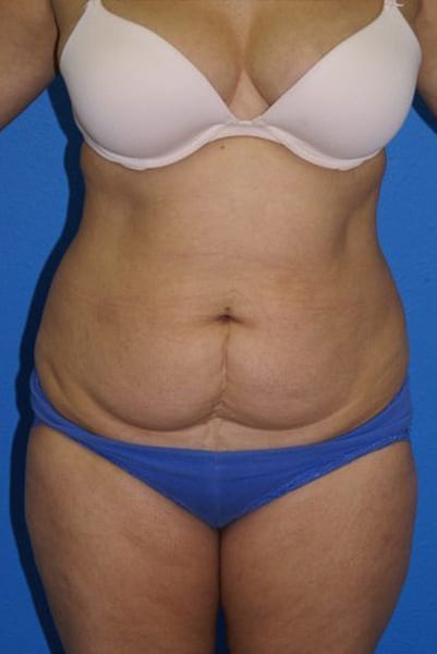 Tummy Tuck Patient 05 View 1 - Before Thumbnail