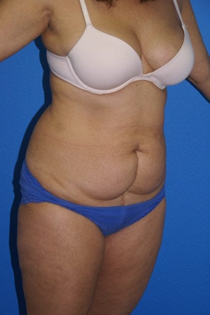 Tummy Tuck Patient 05 View 2 - Before Thumbnail
