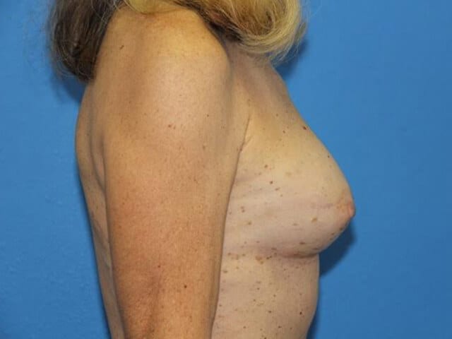 Breast Reconstruction with Fat Transfer Patient 02 View 2 - After Thumbnail