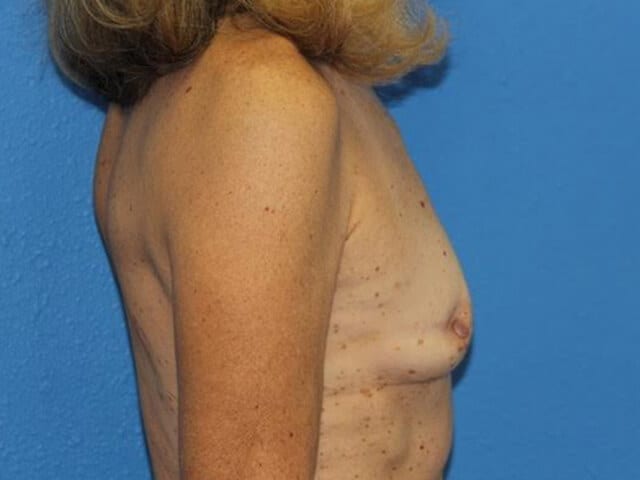 Breast Reconstruction with Fat Transfer Patient 02 View 2 - Before Thumbnail