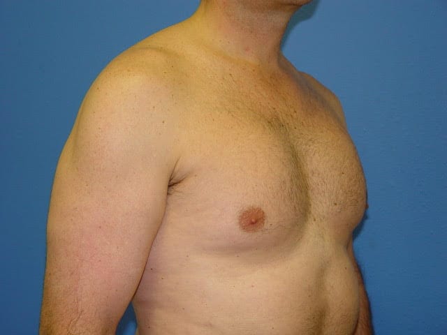 Pectoral Implants patient 01 View 2 - After Thumbnail