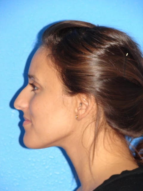 Rhinoplasty Patient 03 View 4 - Before Thumbnail