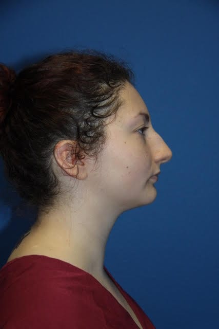Rhinoplasty Patient 05 View 4 - Before Thumbnail