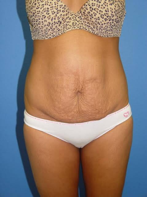 Tummy Tuck Patient 07 View 1 - Before Thumbnail