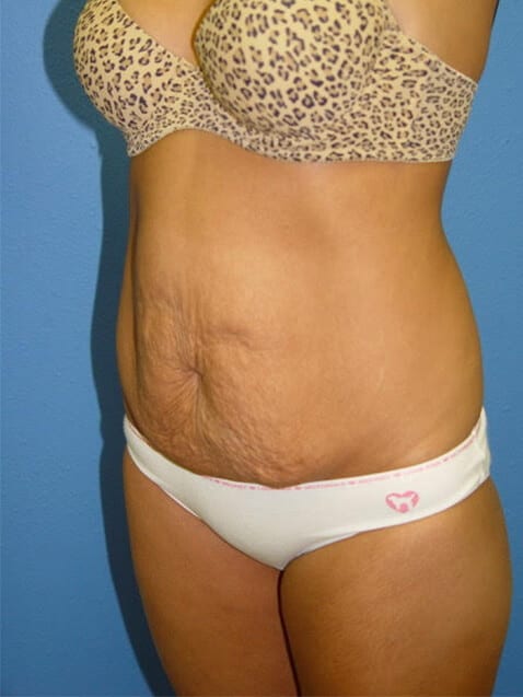 Tummy Tuck Patient 07 View 2 - Before Thumbnail