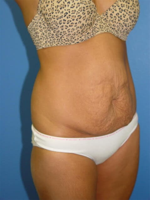 Tummy Tuck Patient 07 View 4 - Before Thumbnail