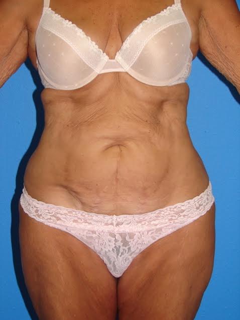 Tummy Tuck Patient 08 View 1 - Before Thumbnail