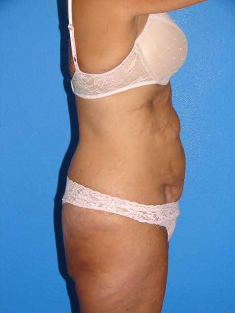 Tummy Tuck Patient 08 View 3 - Before Thumbnail