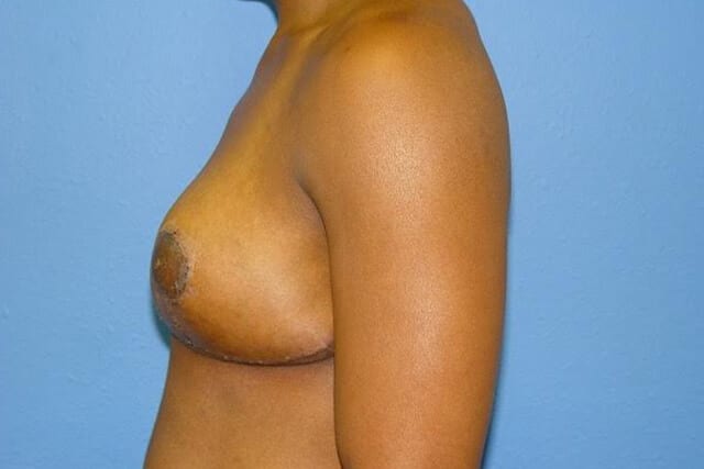 BREAST REDUCTION PATIENT 03 View 2 - After Thumbnail