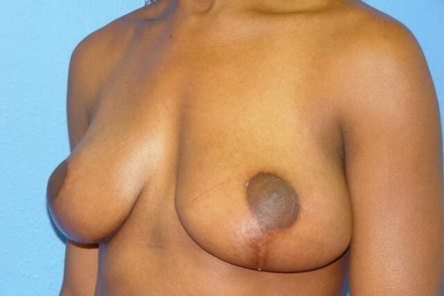 BREAST REDUCTION PATIENT 03 View 1 - After Thumbnail